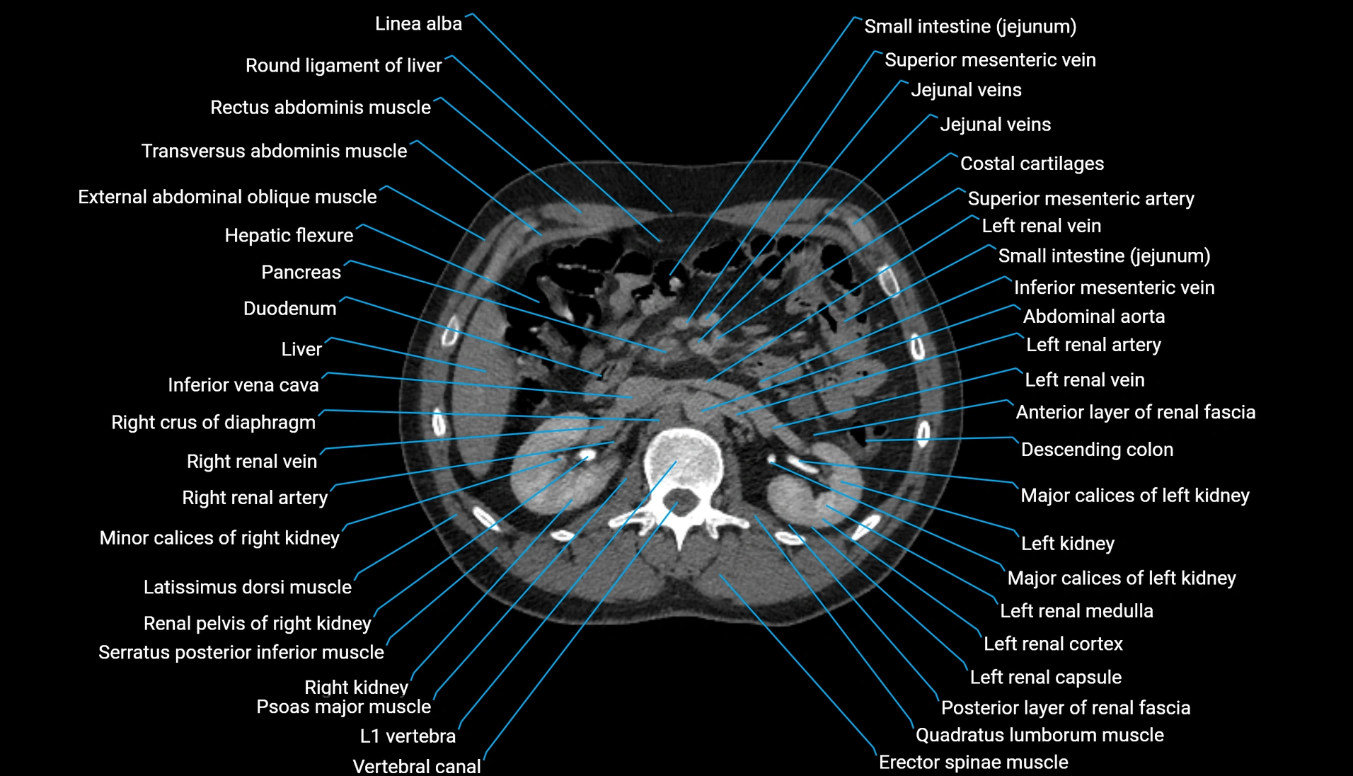 CT urogram axial cross sectional anatomy  labelled radiology image-00100.webp